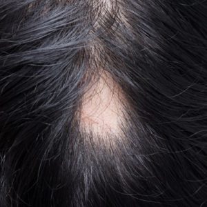 trixoptosi kefali maliia