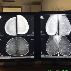 mastografos aktinografia