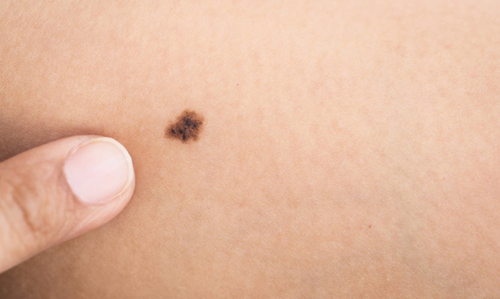 elia derma melanoma aftodioikisi.jpg